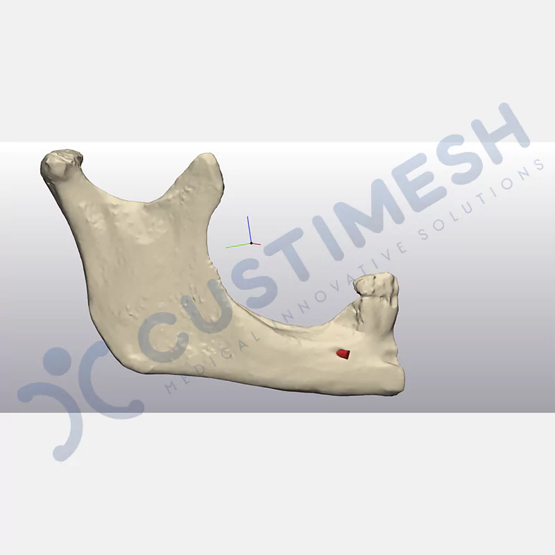 custimesh-mesh-titaniummesh-vaka3-2