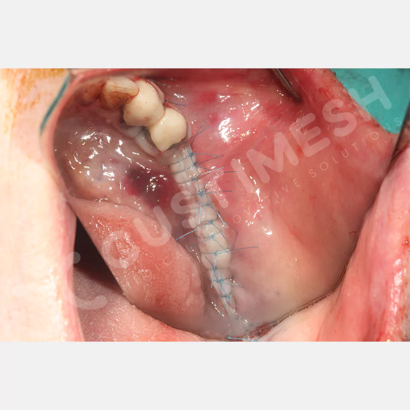 custimesh-mesh-titaniummesh-vaka3-20