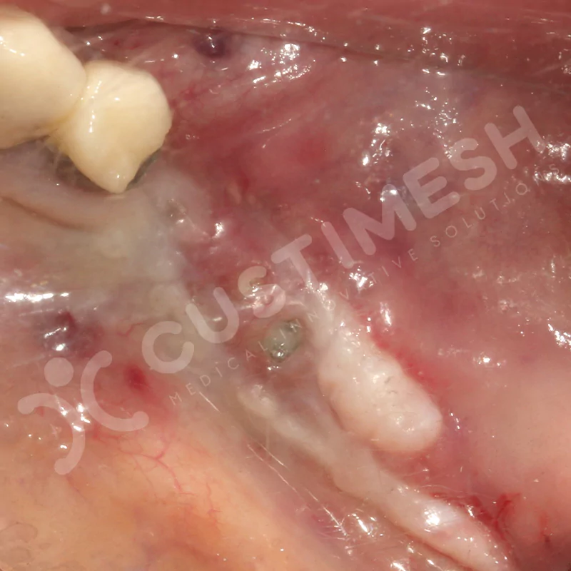 custimesh-mesh-titaniummesh-vaka3-21