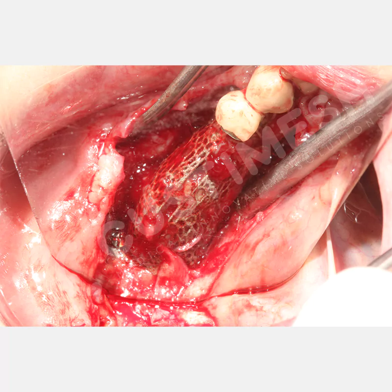 custimesh-mesh-titaniummesh-vaka3-22