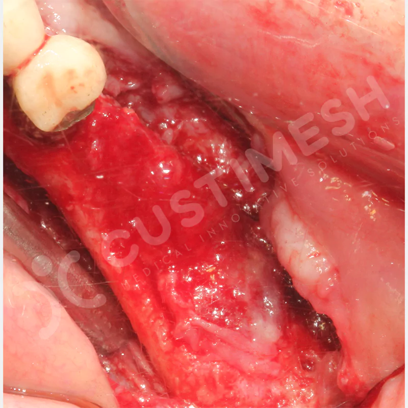 custimesh-mesh-titaniummesh-vaka3-24