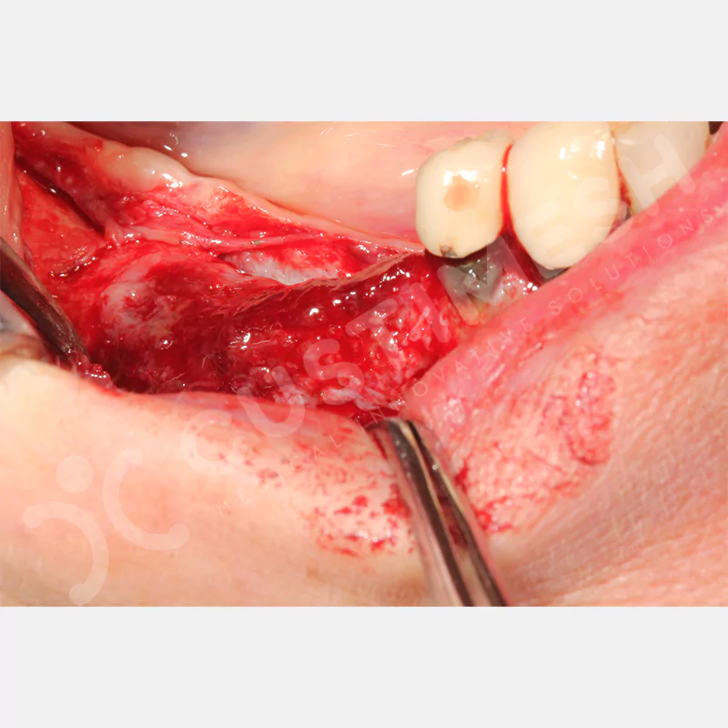 custimesh-mesh-titaniummesh-vaka3-25