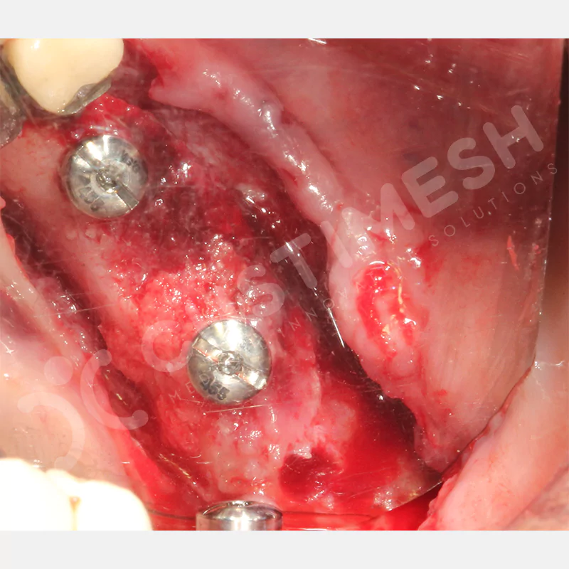 custimesh-mesh-titaniummesh-vaka3-26