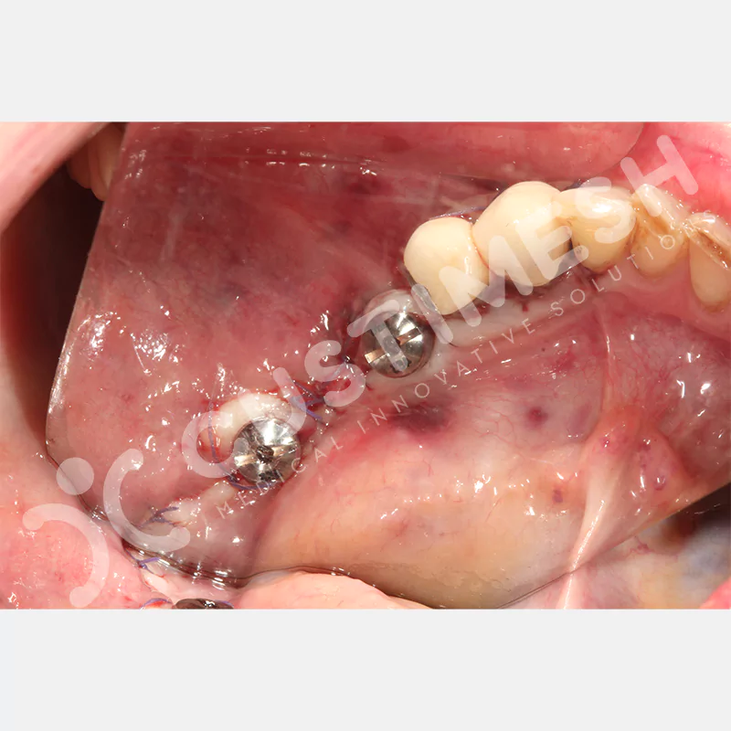 custimesh-mesh-titaniummesh-vaka3-27