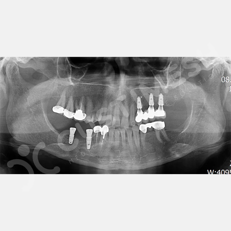 custimesh-mesh-titaniummesh-vaka3-28