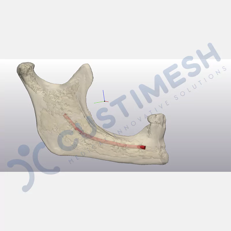 custimesh-mesh-titaniummesh-vaka3-3