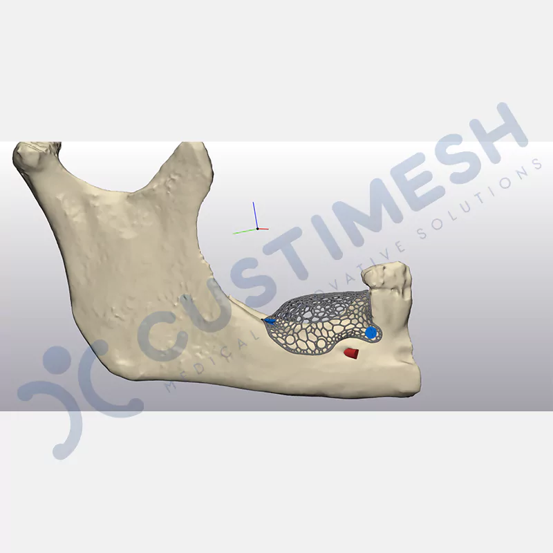 custimesh-mesh-titaniummesh-vaka3-4