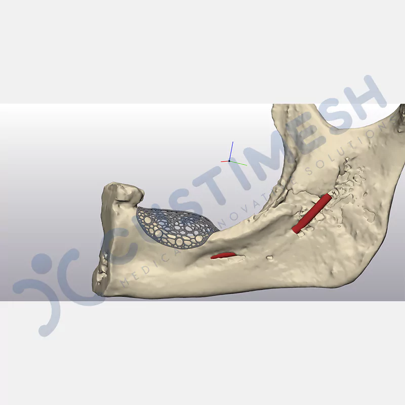 custimesh-mesh-titaniummesh-vaka3-6