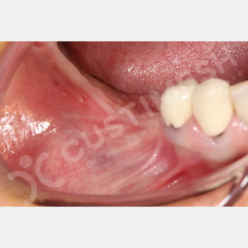 custimesh-mesh-titaniummesh-vaka3-8