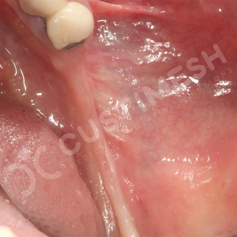 custimesh-mesh-titaniummesh-vaka3-9